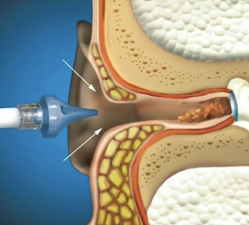 Earwax Removal Kit - Earwax Cleaning & Maintenance Kit