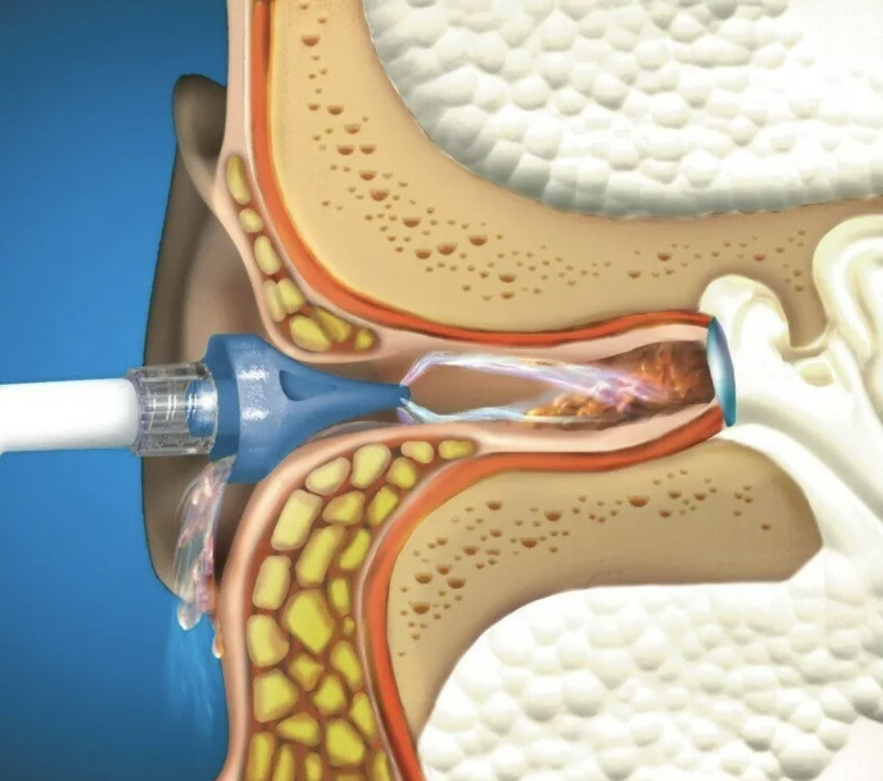 Earwax Removal Kit - Earwax Cleaning & Maintenance Kit